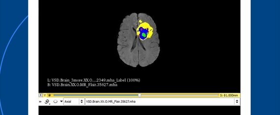 Erstellung einer App für die Lokalisation des Hirntumors